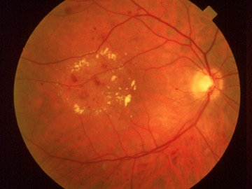 Retina_CSME lipid